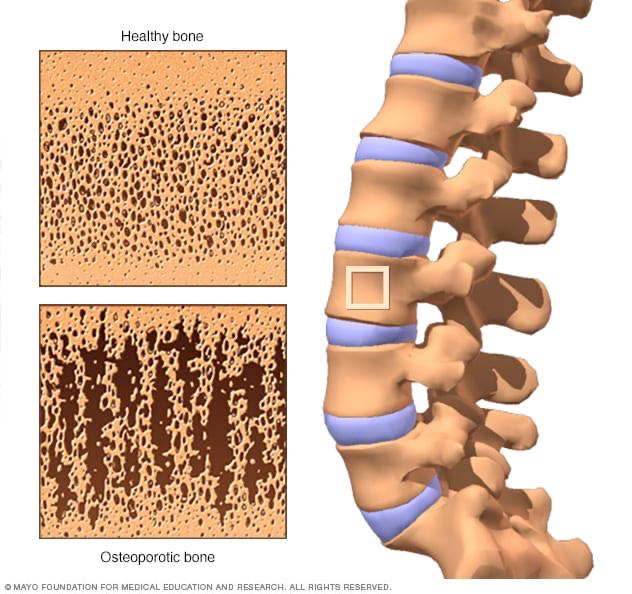 Osteoporosis: A Hidden Threat to Bone Strength
