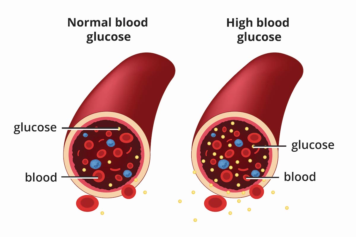 Diabetes Mellitus: A Metabolic Disorder of Blood Sugar Regulation