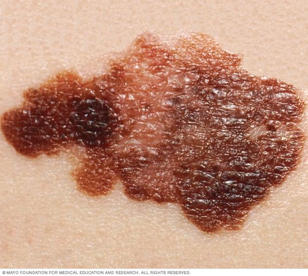 The Hidden Threat on Your Skin: What You Need to Know About Skin Cancer