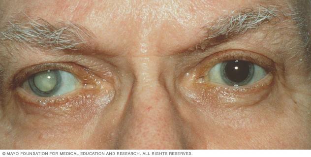 What Is a Cataract? Causes, Symptoms, and Treatment