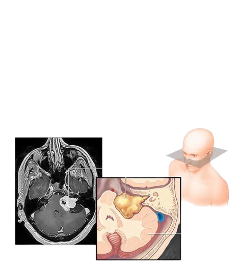 Brain Tumors Explained: From Brain Tissue to Surrounding Structures