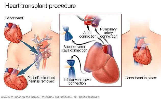 Heart Transplant as Advanced Therapy for End-Stage Heart Failure