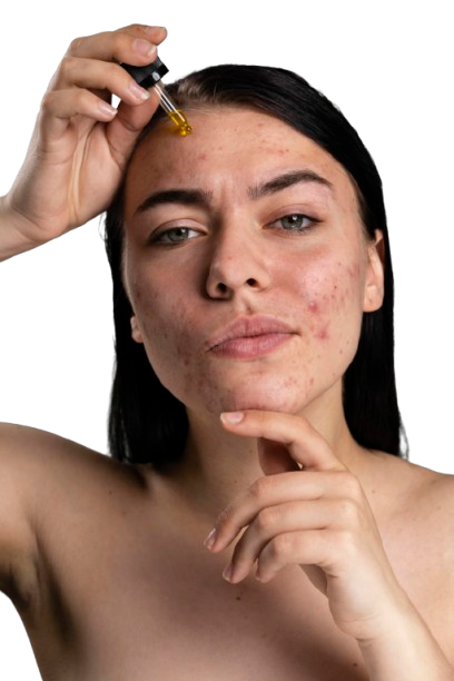 Effective Tips for Preventing and Treating Pimples Safely