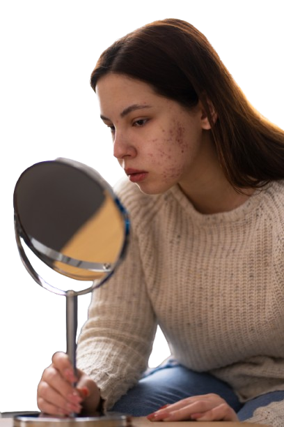 Acne: Causes, Symptoms, and Effective Treatment Solutions