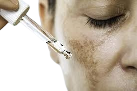 Effective Treatments for Dark Spots: Causes, Prevention, and Remedies